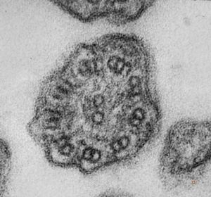 F,5y. | immotile cilia syndrome - nasal mucosa